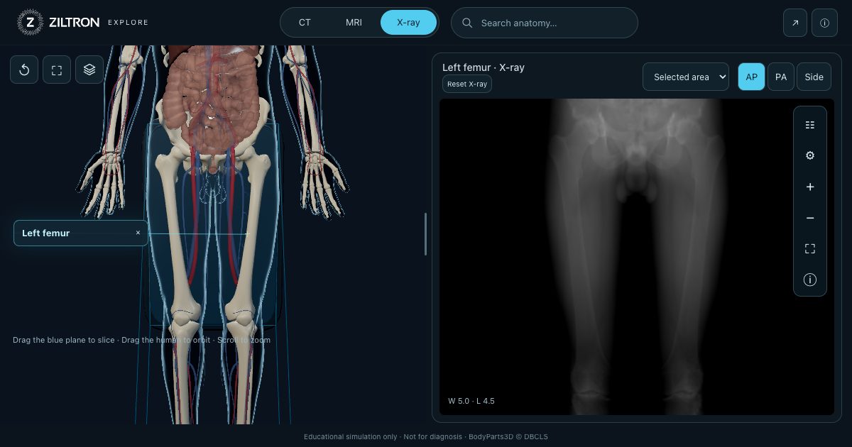 Left femur — representative X-ray view
